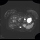 Focal nodular hyperplasia, liver, SPIR: MRI - Magnetic Resonance Imaging